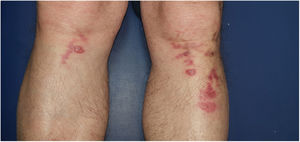 Reddish-violaceous plaques with tense serosanguineous blisters, tracing a reticular pattern. At the time the photograph was taken, the lesions had been present for only a few days.