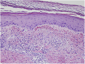 Orthokeratotic hyperkeratosis in the stratum corneum, atypia consisting of keratinocytes in the epidermis, and marked extravasation of blood. Mild superficial perivascular infiltrate of lymphocytes and monocytes.