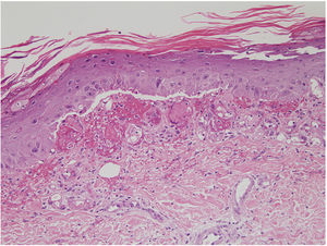 Hyperkeratosis in the stratum corneum, atypia in the epidermis, and extravasated blood and edema in the papillary dermis.