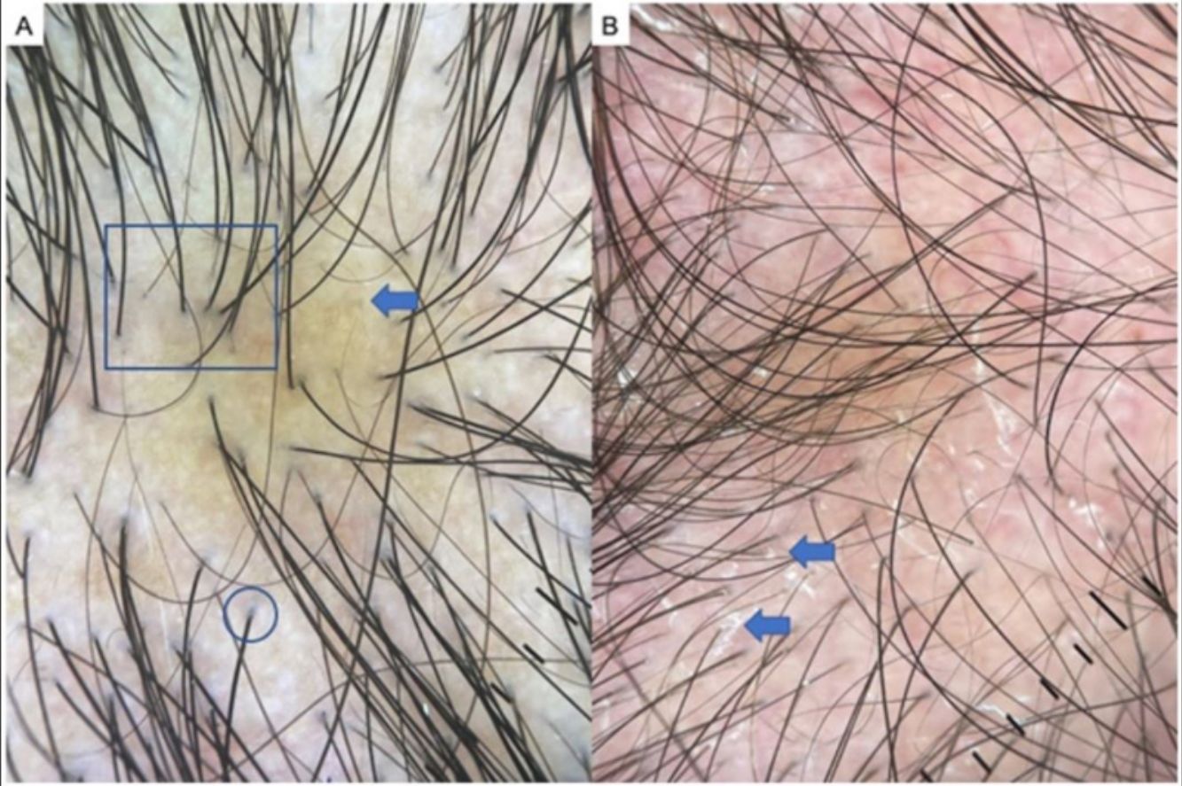 [Translated article] Trichoscopy: An Update | Actas Dermo-Sifiliográficas