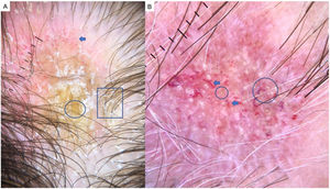 Chronic discoid lupus erythematosus. A, Absence of follicular openings, keratotic plugs, and giant yellow dots (circle), coarse perifollicular hyperkeratosis (square), and aberrant vascular patterns (giant capillaries, thick arborizing vessels, and fine telangiectasia) (arrow). B, Detail of the keratotic plugs (circles) and arborizing vessels (arrows).
