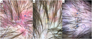 A, Folliculitis decalvans. Note tufted hairs— i.e., more than 5 hairs emerging from a follicular root (square), diffuse erythema (arrow), and follicular hyperkeratosis, or yellowish hair casts/scaling (circle). B, Detail of tufted hairs (square). C, Dissecting cellulitis of the scalp. Note the black dots or cadaver hairs (square), vellus hair (circle), and broken hairs (arrows).