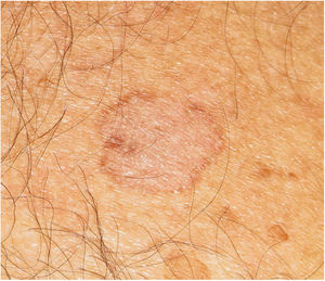 Clinical image. Pale brown 1.5-cm spot with eccentric pigmentation.