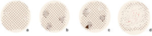 Modified dermoscopic extrafacial lentigo maligna progression model adapted from Gamo-Villegas et al.2 A, Reticular disruption. B, Erased area and triangular structures. C, Angulated and zig-zag lines. D, Large areas.