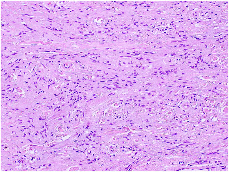 [Translated article] Pedunculated Papule on the Sole of the Foot ...