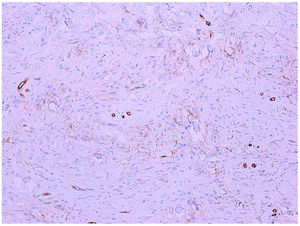 Immunohistochemical staining for CD34, 200×.