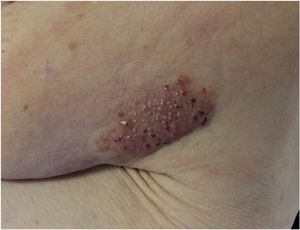 First visit. Left shoulder: red-violaceous plaque measuring 8cm×5cm with a pseudovesicular and clustered surface.