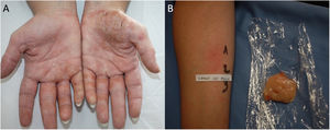 Protein contact dermatitis caused by chicken meat. (A) Chronic hand eczema. (B) Positive prick-prick result with chicken meat.