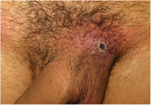 Lesion at inoculation site. Confluent pseudopustules with a depressed necrotic center associated with perilesional erythema and edema.