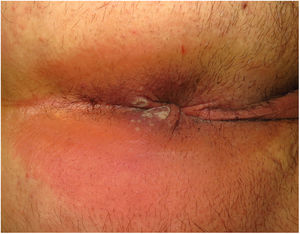 Multiple perianal pseudopustules, some crater-shaped with erosive centers.