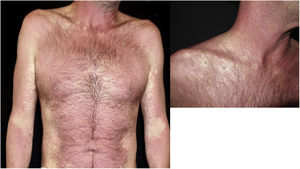 Erythematosus skin affected by cutaneous drug reaction and the molluscum contagiosum virus lesions with the perilesional skin respected with a whitish halo.