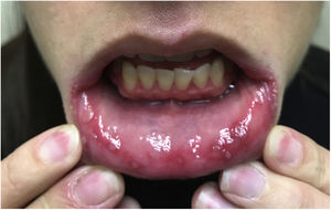 Multiple 2–5-mm shallow ulcers with an erythematous base on the patient's lower labial mucosa and lateral borders of her tongue.