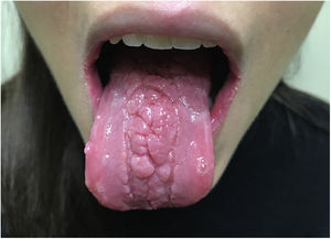 Deep interlocking fissures imparting a nodular appearance to the middle third of the tongue; the lateral thirds of the tongue show a smooth, atrophic appearance.