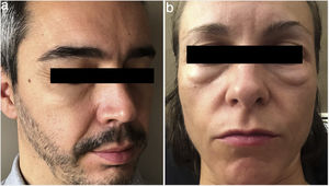a) Edema periorbitario en un hombre de 40 años en tratamiento con minoxidil oral 5mg/día. b) Edema periorbitario en una mujer de 37 años en tratamiento con minoxidil oral 1mg/día.