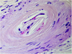 Histopathological examination of the skin biopsy: biconvex, needle-shaped clefts inside the arterioles of the dermis (hematoxylin–eosin 40×).