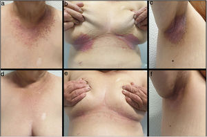Darier disease, patient 1. (A–C) Pretreatment; (D–F) Improvement after 10 weeks of treatment with acitretin 25mg and diclofenac sodium 3% gel twice daily.