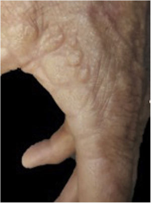 Imagen clínica. Se aprecian las lesiones de aspecto nodular en el margen palmodorsal de la mano izquierda.