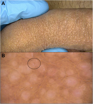 Presentación del caso. Panel A: Presentación clínica. Panel B: Hallazgos dermatoscópicos (obtenidas mediante el uso de dermatoscopio digital Fotofinder® a 20 aumentos). Se observan múltiples áreas blanquecinas, algunas con un punto central identificable más oscuro (marcado en la figura con un óvalo).