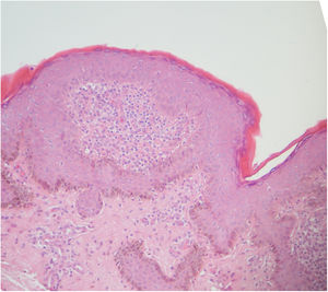 Hallazgos histológicos de la biopsia efectuada con sacabocados. Tinción de hematoxilina-eosina.
