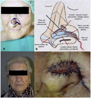 Ilustración de la técnica quirúrgica del colgajo musculocutáneo nasalis. a) Diseño del colgajo. b) Dibujo ilustrativo del levantamiento del colgajo y las estructuras anatómicas visualizadas. c) Postoperatorio a los 15 días. d) Avance y cierre en V-Y el defecto intraoperatorio.