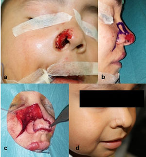 Ilustración de la técnica quirúrgica del colgajo musculocutáneo nasalis de pared lateral nasal. a) Extirpación de lesión en ala nasal derecha con extirpación parcial de triángulo blando. b) Diseño del colgajo adaptado a la morfología del reborde alar. c) Rotación del colgajo sobre pedículo vascular. c) Postoperatorio a los 21 días.