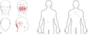a)Localización inicial de las lesiones de tinea capitis recogidas en el presente estudio, marcadas con puntos rojos. Nótese la predilección por las zonas de rasurado o degradado (nuca y zona temporal). b)Extensión a otras localizaciones en la presente serie, marcadas con puntos azules.