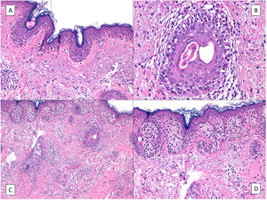A) Los melanocitos de la capa basal son más numerosos de lo normal y se distribuyen de forma irregular y no equidistante en la capa basal epidérmica, sobre una dermis con elastosis solar evidente. B) Apolillamiento de un folículo piloso por los melanocitos neoplásicos de un lentigo maligno. C) Predominio de nidos junturales irregulares y confluentes en un lentigo maligno con aspecto simulador de nevus juntural displásico. D) La atipia de los melanocitos, el aspecto irregular de los nidos, y sobre todo la elastosis solar, facilitan el diagnóstico de lentigo maligno.