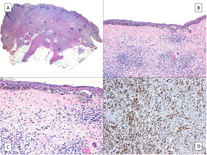 Melanoma desmoplásico. A) Aspecto característico en la panorámica de un tumor que infiltra todo el espesor de la dermis con infiltración de la hipodermis salpicado de nódulos linfoides. B) El componente in situ del melanoma desmoplásico es idéntico a un lentigo maligno. C) Detalle del componente juntural con melanocitos apolillando las capas basales de la epidermis y un nido juntural de melanocitos atípicos a la derecha de la imagen. D) Tinción inmunohistoquímica positiva para SOX-10 en los núcleos del componente dérmico del melanoma desmoplásico.