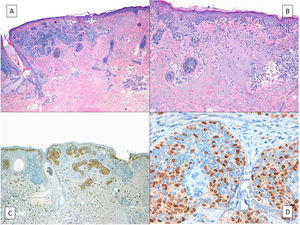 A) Lentigo maligno (mitad derecha de la imagen) que infiltra un carcinoma basocelular (mitad izquierda). B) Detalle del lentigo maligno con formación de nidos irregulares de melanocitos atípicos en la unión dermo-epidérmica y marcada elastosis solar. C) y D) Tinción inmunohistoquímica positiva nuclear para MITF que realza los melanocitos del lentigo maligno in situ que salpican también profusamente los islotes epiteliales del carcinoma basocelular.