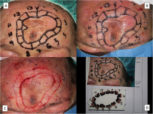 Técnica de la extirpación del lentigo maligno mediante cirugía de Mohs diferida. A) Marcado prequirúrgico de los límites clínicos del tumor, el margen de 5mm y diseño de los fragmentos del margen a analizar. B) Referencia de las secciones a analizar con suturas de nylon a 1cm de distancia del margen quirúrgico. C) Secciones ya realizadas y punto de sutura de referencia de la sección número uno para el procesamiento posterior. D) Secciones ya dispuestas numeradas y fijadas con alfileres a un corcho. Todos los márgenes se pintan con tinta china excepto el margen quirúrgico que es el que interesa estudiar en el Mohs diferido.