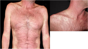 Piel eritematosa afectada de reacción adversa a medicamento y lesiones por virus del molluscum contagiosum con preservación de la piel perilesional con halo blanquecino.
