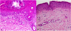 A) Infiltrado inflamatorio linfocítico superficial con vacuolización de la zona basal y queratinocitos necrósicos. B) Ausencia de compromiso de la unión dermoepidérmica o de infiltrado inflamatorio.