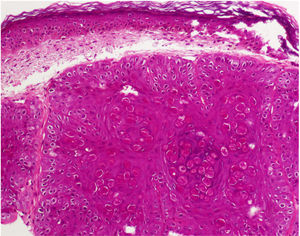 Cuerpos de Henderson-Paterson, característicos del virus del molluscum contagiosum.