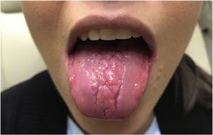 Mejoría tras 10 días de tratamiento con aciclovir. Los síntomas de la paciente desaparecieron completamente tras el periodo de tratamiento.