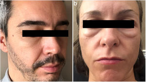 A, Periorbital edema in a 40-year-old man treated with oral minoxidil (5mg/d). B, Periorbital edema in a 37-year-old woman treated with oral minoxidil (1mg/d).