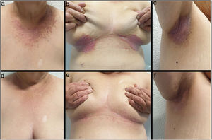 Enfermedad de Darier, paciente 1. A-C) Pretratamiento; D-F) Mejoría tras 10 semanas de tratamiento con acitretina 25mg y gel de diclofenaco sódico al 3%/2 veces al día.