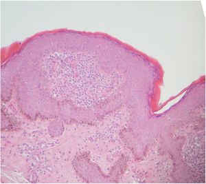 Punch biopsy histology (hematoxylin–eosin).