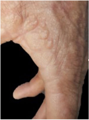 [Translated article] Acral Lesions With a Nodular Appearance: A Case ...