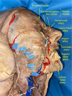 Anatomic dissection by the authors in which the 2 main sources of irrigation of the nasal pyramid are identified: dorsal artery of the nose from the ophthalmic artery and the angular artery and its branches from the facial artery. The divisions of the facial nerve are highlighted with contrast.