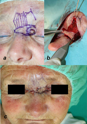 Illustration of the different steps for designing and detaching the procerus perforator flap. (a) Flap design. The direction of the procerus muscle fibers and the outflow of the supratrochlear artery are marked on the skin. (b) Dissection and detachment of the flap below the muscle plane. (c) Advancement and closure of the V-Y defect.
