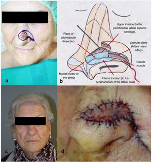 Illustration of the surgical technique of the nasalis musculocutaneous flap. (A) Flap design. (B) Illustrative drawing of detachment of the flap and the anatomic structures exposed. (C) Postoperative outcome after 15 days. (D) Advancement and closure of the intraoperative V-Y defect.