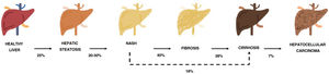 Progression of metabolic-associated fatty liver disease. From steatosis (stable, with little risk of progression, characterized by the accumulation of intracellular fat in the hepatocyte) to nonalcoholic steatohepatitis (NASH) (fat accumulation accompanied by inflammatory changes and cell damage) and hepatic fibrosis (collagen deposition in the form of fibrous septa that cause architectural remodeling and progressive hepatocyte dysfunction). Fibrosis predisposes to the development of cirrhosis (fibrotic septa and regeneration nodules) and hepatocelular carcinoma and/or liver failure.6,8,10,12–14