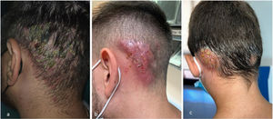 Inflammatory forms.
