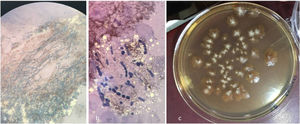 (A) Parasitization in the KOH examination. (B) Septate hyphae and arthroconidia in the KOH examination. (C) Isolate of T. tonsurans in glycosylated Sabouraud agar with actidione.