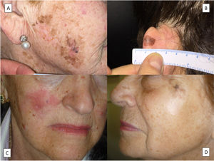 Clinical features of lentigo maligna. A, Large patch with ill-defined edges showing different shades of brown with reddish and black areas on the right cheek. B, Brownish patch with black areas and ill-defined edges on the left ear. C, Red patch with indistinct borders on the right cheek. Note the scar in the right nasolabial fold from a previous lentigo maligna treated with conventional excision. D, White patch in the lower half of a lentigo maligna on the left cheek. The lesions in C and C showed no histologic evidence of regression.