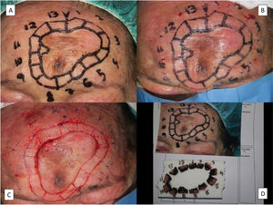 Removal of lentigo maligna by slow Mohs micrographic surgery. A, Presurgical delineation of tumor, the 5-mm margin, and design of the margin segments to be analyzed. B, Nylon sutures used to mark the sections at a distance of 1cm from the surgical margin. C, Prepared sections and orienting suture in section 1 for subsequent processing. D, Sections duly arranged, numbered, and pinned to a cork. All the margins except the surgical margin, which is what is analyzed in slow Mohs micrographic surgery, are stained with India ink.