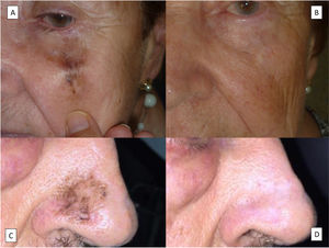 A, Lentigo maligna on the left cheek. B, The same patient as in (A) 3 months after completion of radiotherapy. C, Lentigo maligna on the nose. D, The same patient as in (C) after treatment with imiquimod.