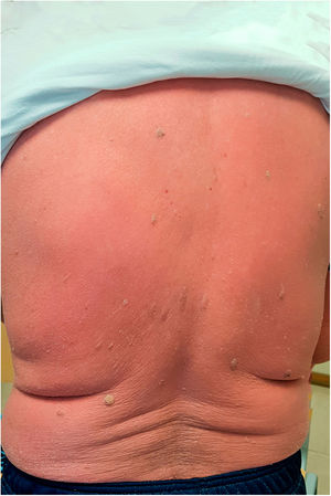 Diffuse erythema on a 71-year-old man