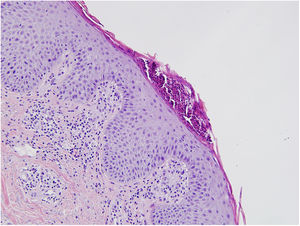 Histological findings concordant with psoriasis: parakeratosis, acanthosis, a microabscess located in the stratum corneum and a lymphohistiocytic infiltrate located in the papillary dermis can be seen (hematoxylin–eosin, 200×).