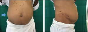 Abdominal distension and crusted plaques involving right T11–T12 dermatomes.